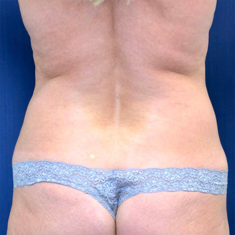 Tummy Tuck