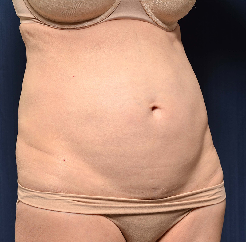 Tummy Tuck