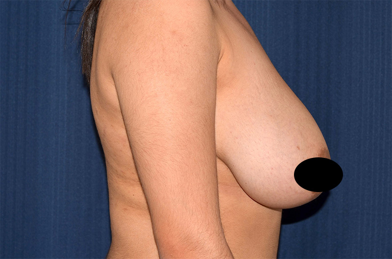 Breast Lift Reduction