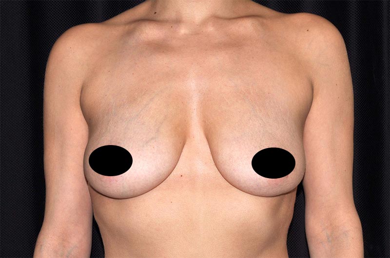 Breast Lift Reduction