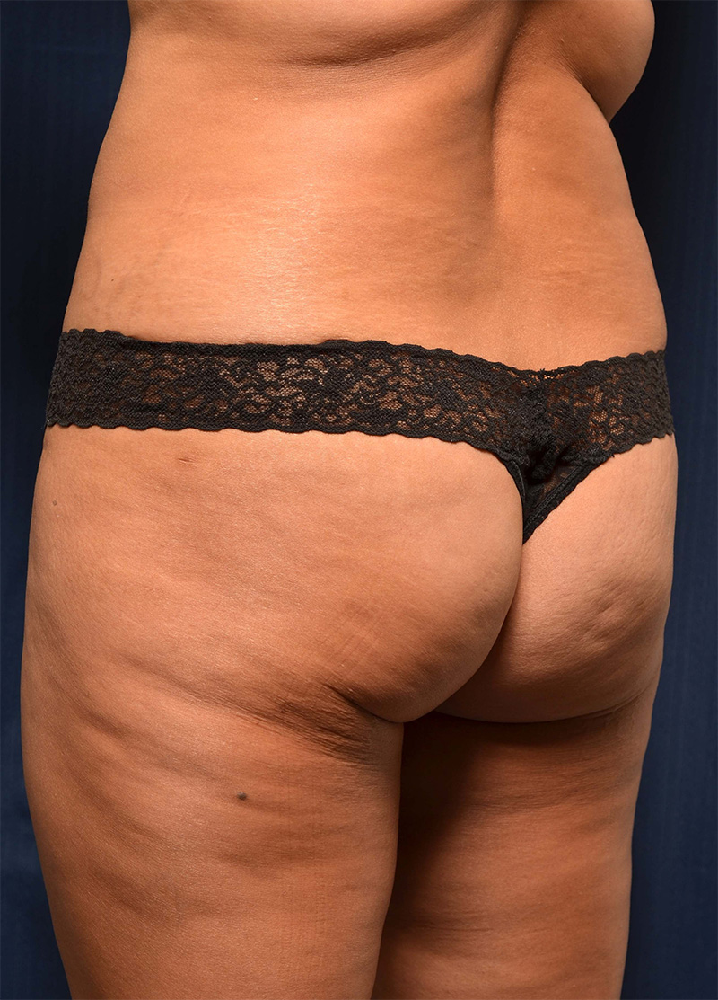 Brazilian Butt Lift Before & After