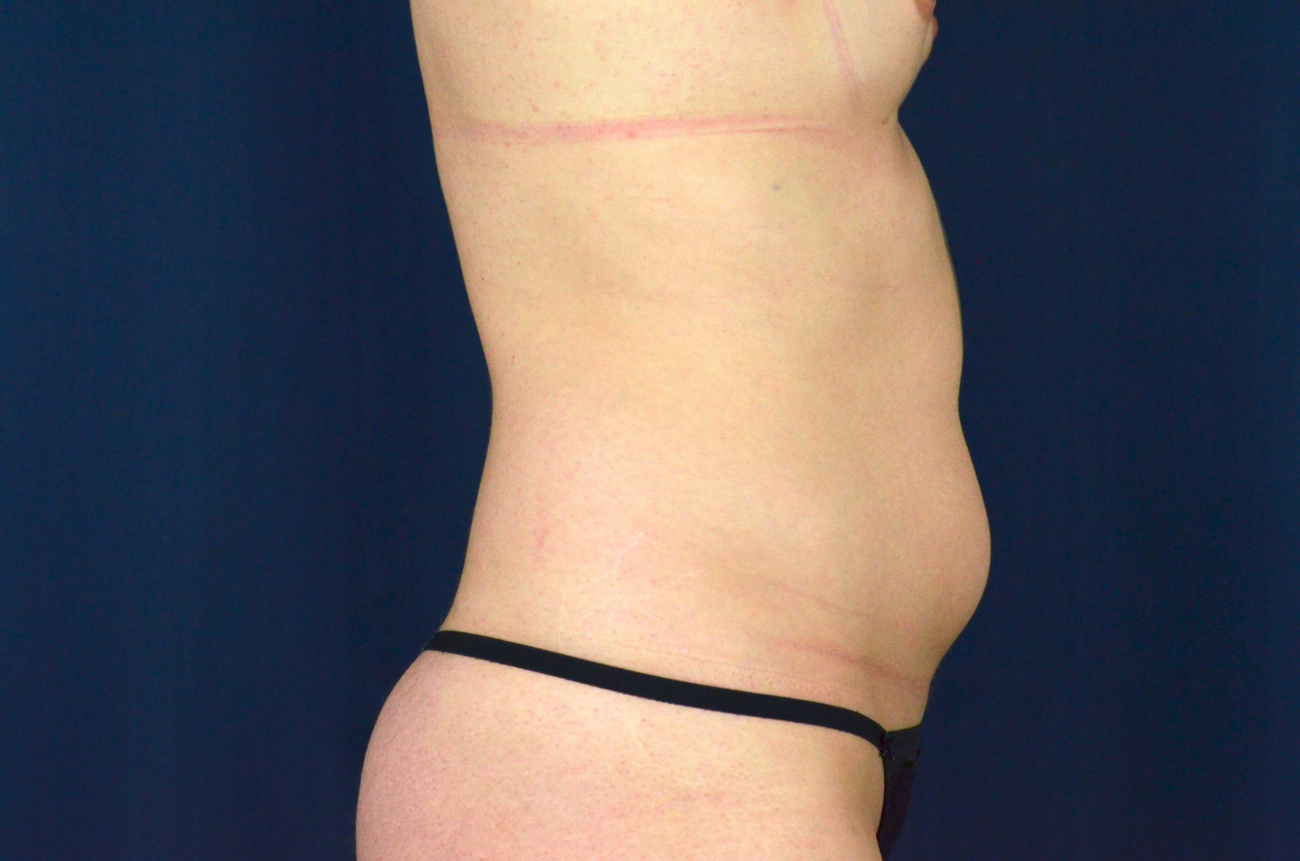 Liposuction