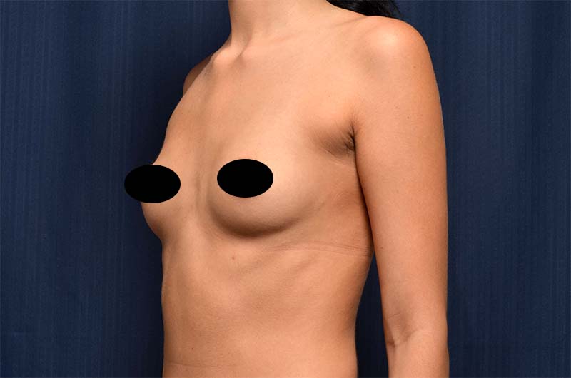 Breast Augmentation Before and After