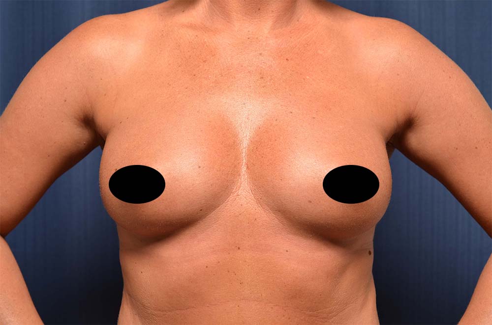 Breast Augmentation Before and After