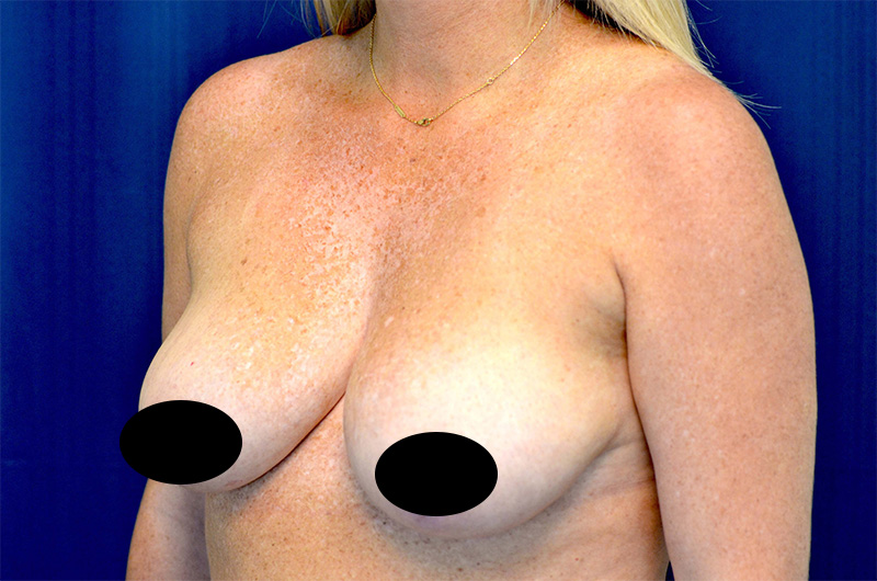 Breast Augmentation with Lift