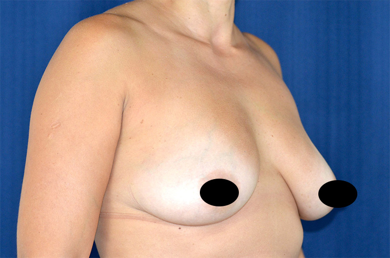 Breast Augmentation with Lift