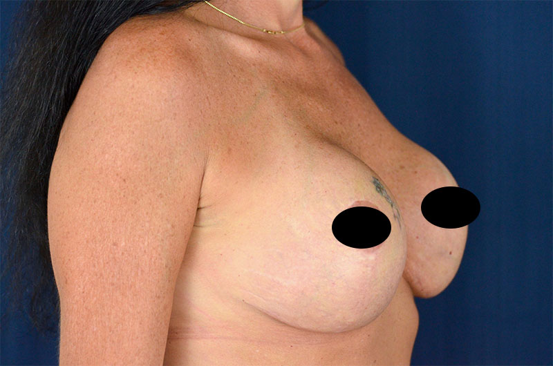 Breast Implant Revision