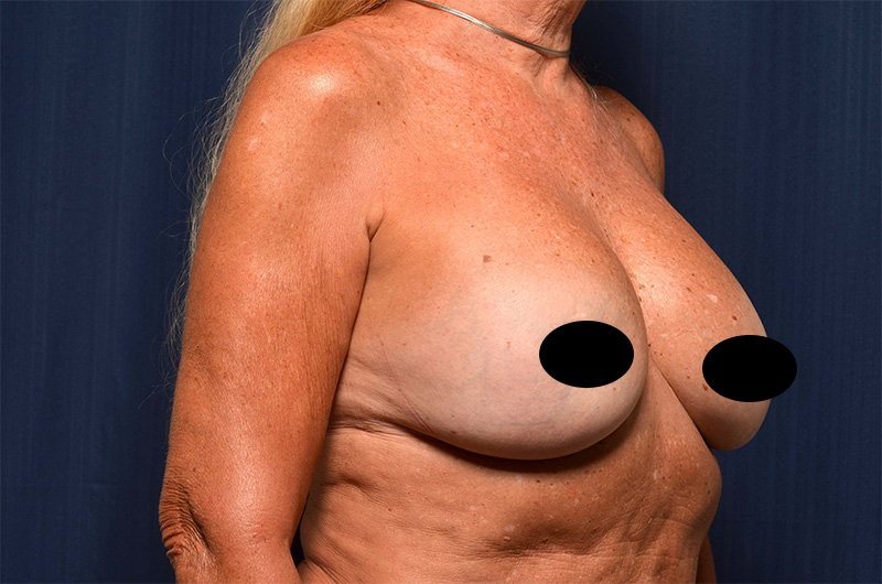 Breast Implant Revision