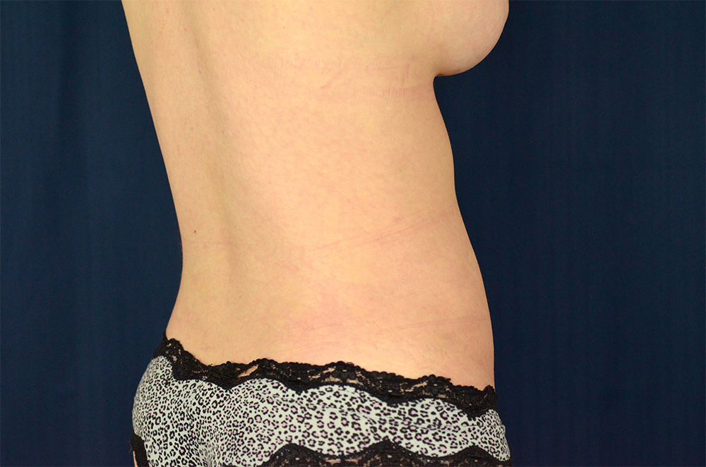 Liposuction