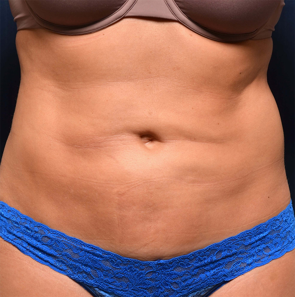 Liposuction