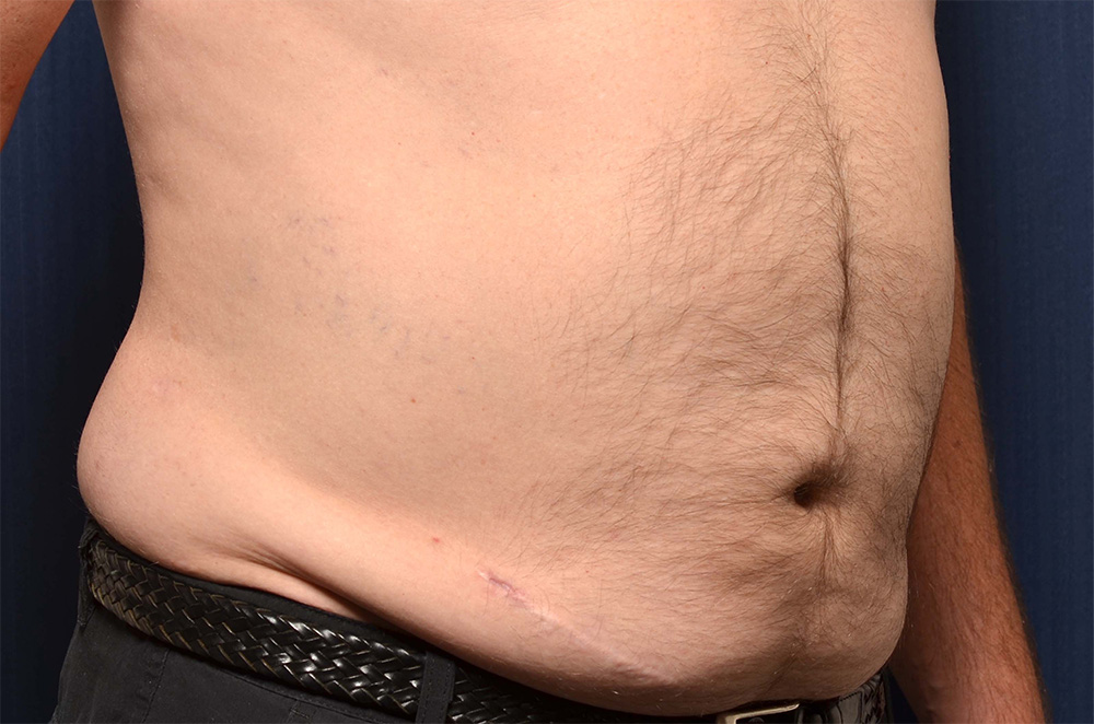 Liposuction