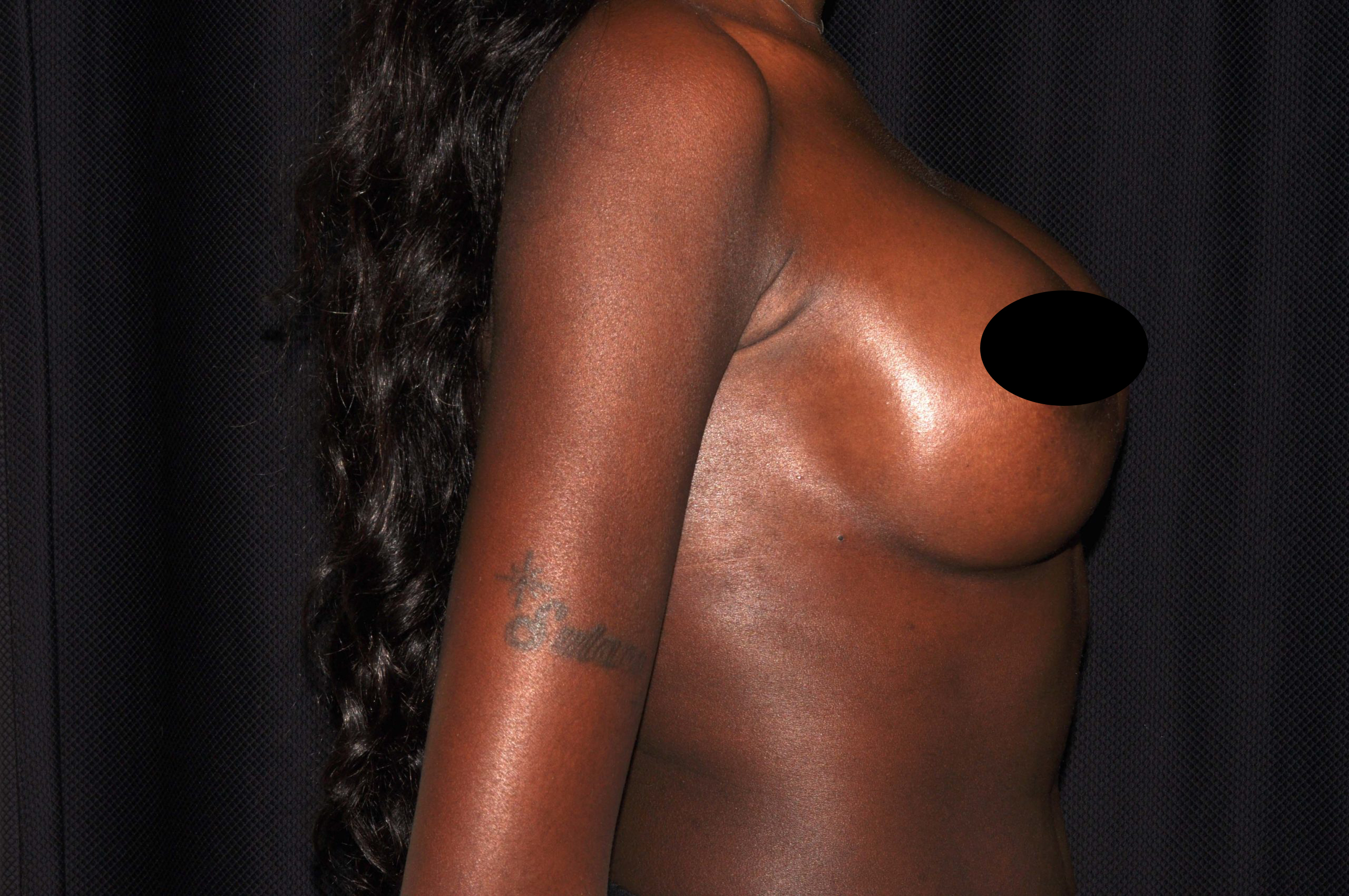 Breast Augmentation Before and After