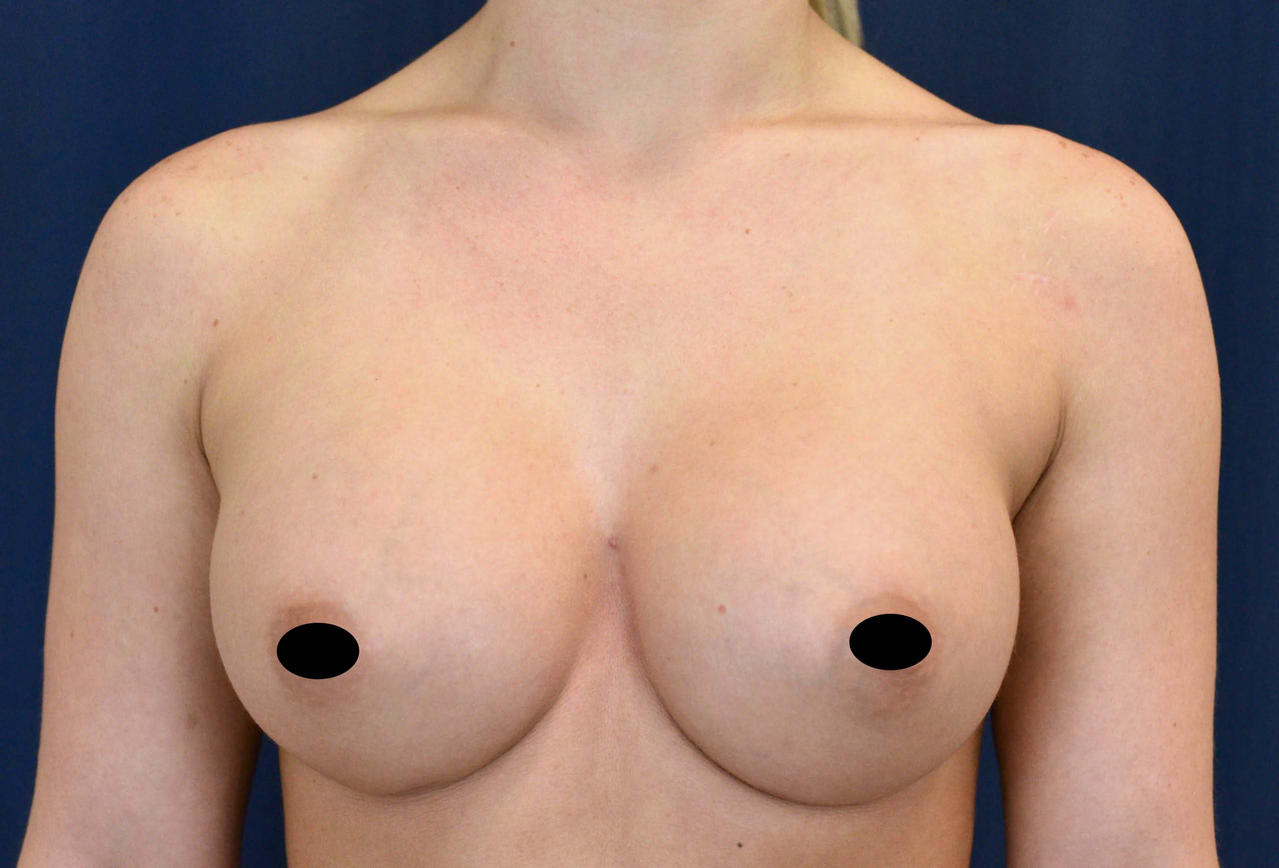 Breast Augmentation Before and After