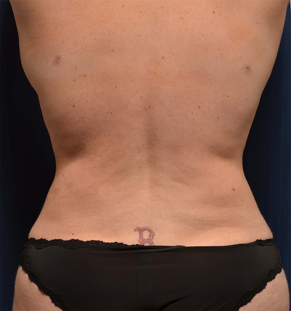 Tummy Tuck
