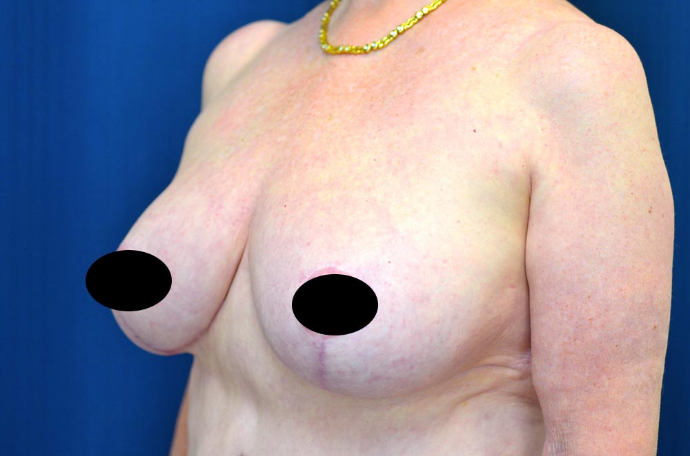 Breast Lift Reduction