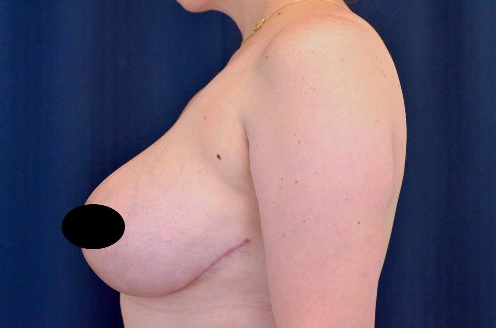 Breast Lift Reduction