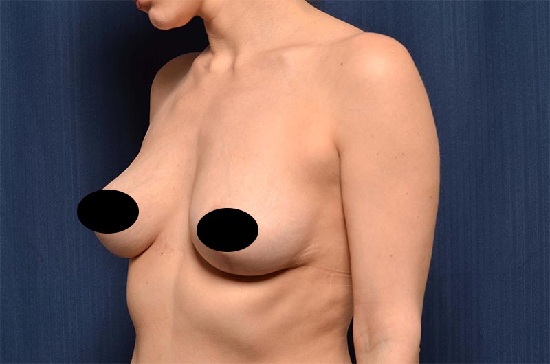 Breast Lift Reduction