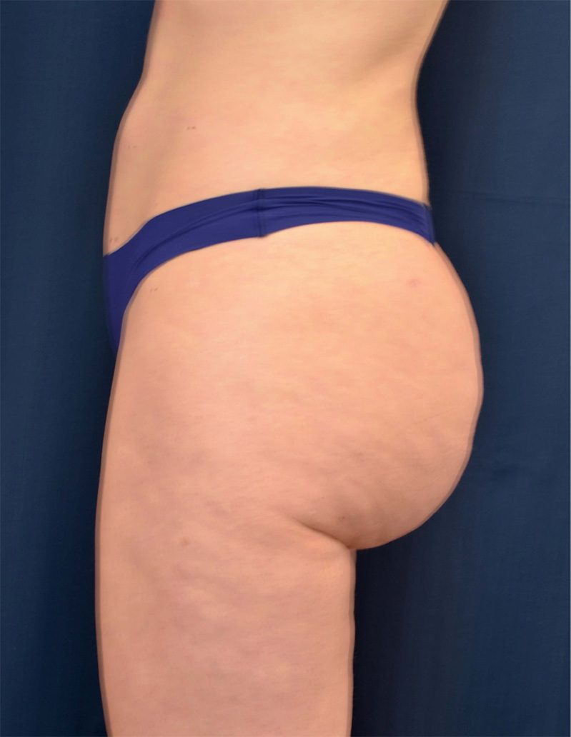 Brazilian Butt Lift Before & After