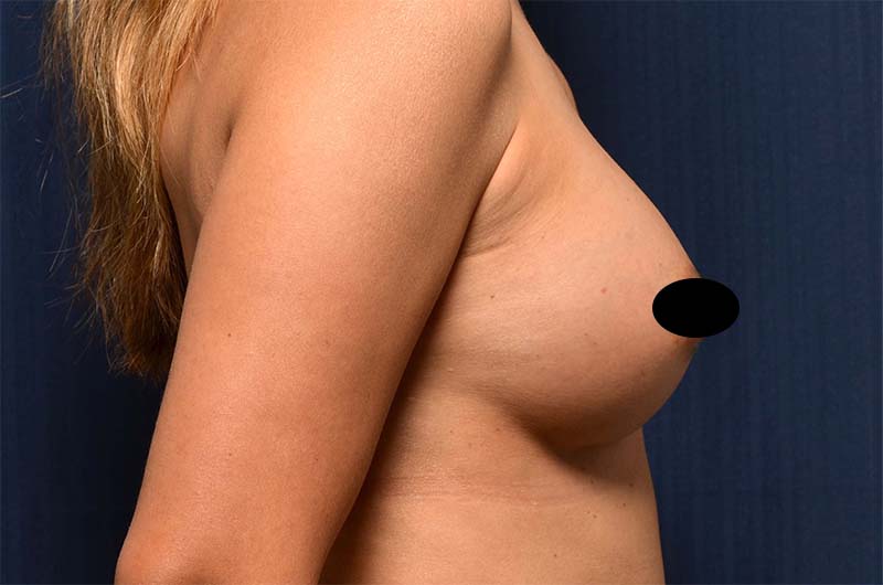 Breast Augmentation Before and After