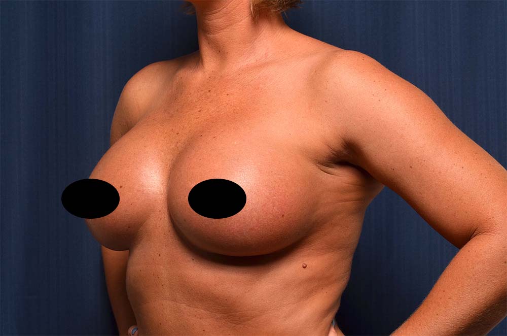 Breast Augmentation Before and After