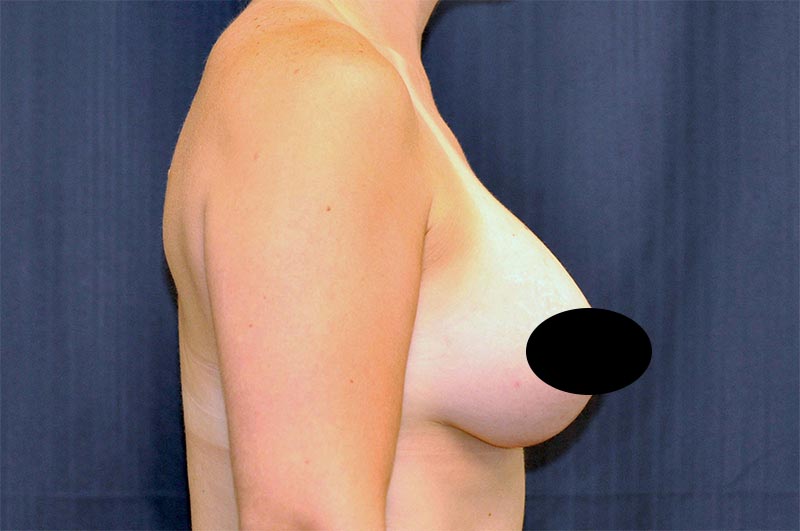 Breast Augmentation with Lift