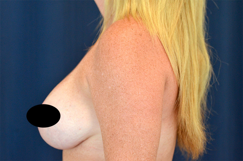 Breast Augmentation with Lift