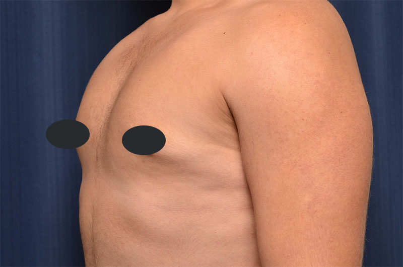 Gynecomastia