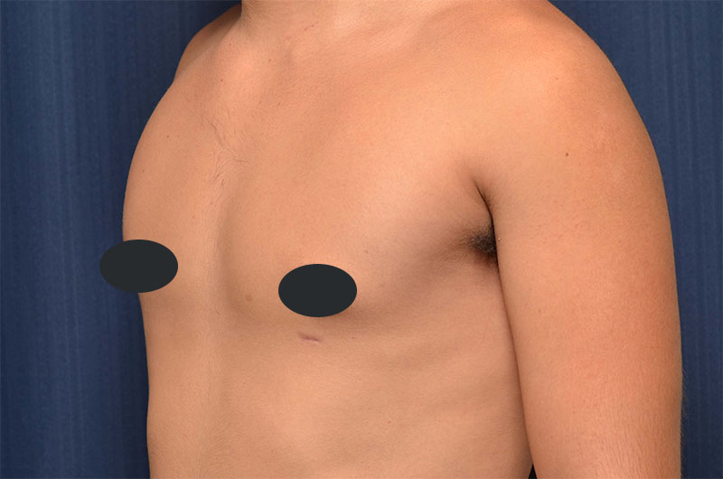 Gynecomastia