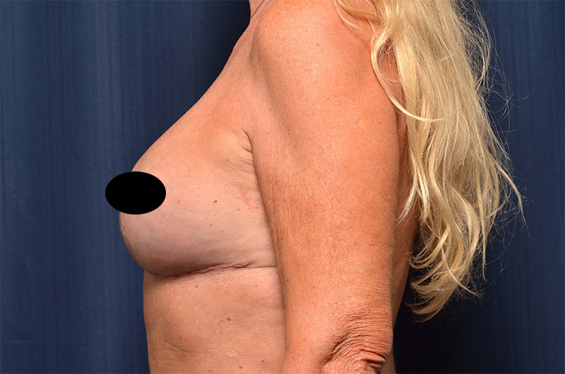 Breast Implant Revision