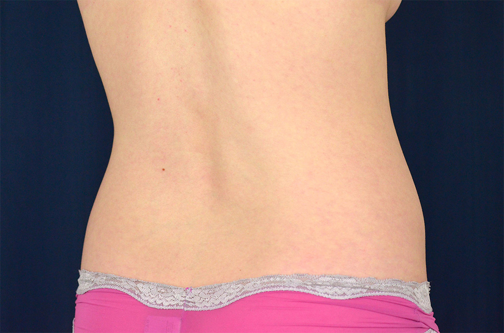 Liposuction
