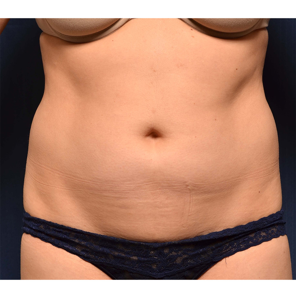 Liposuction