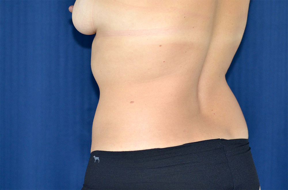 Liposuction