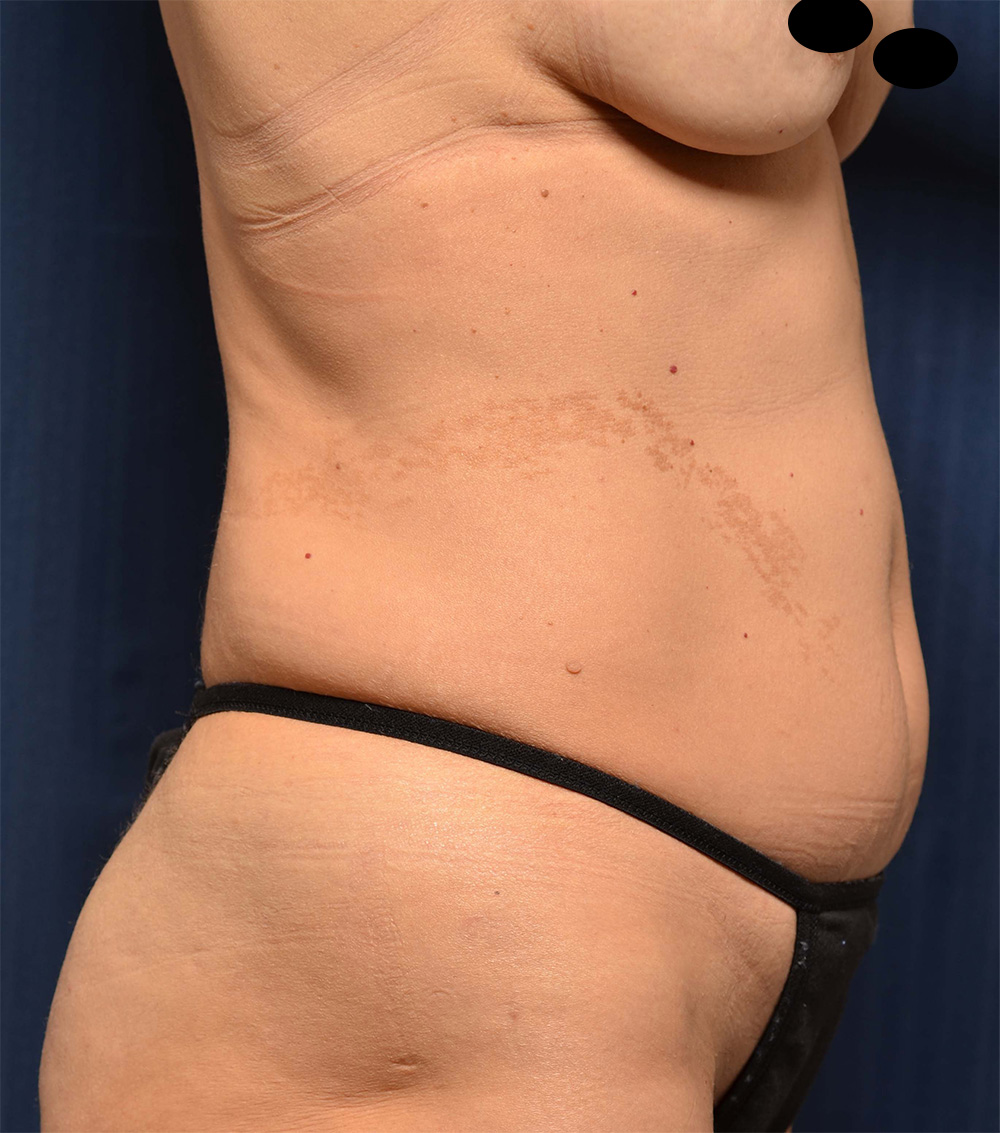 Liposuction