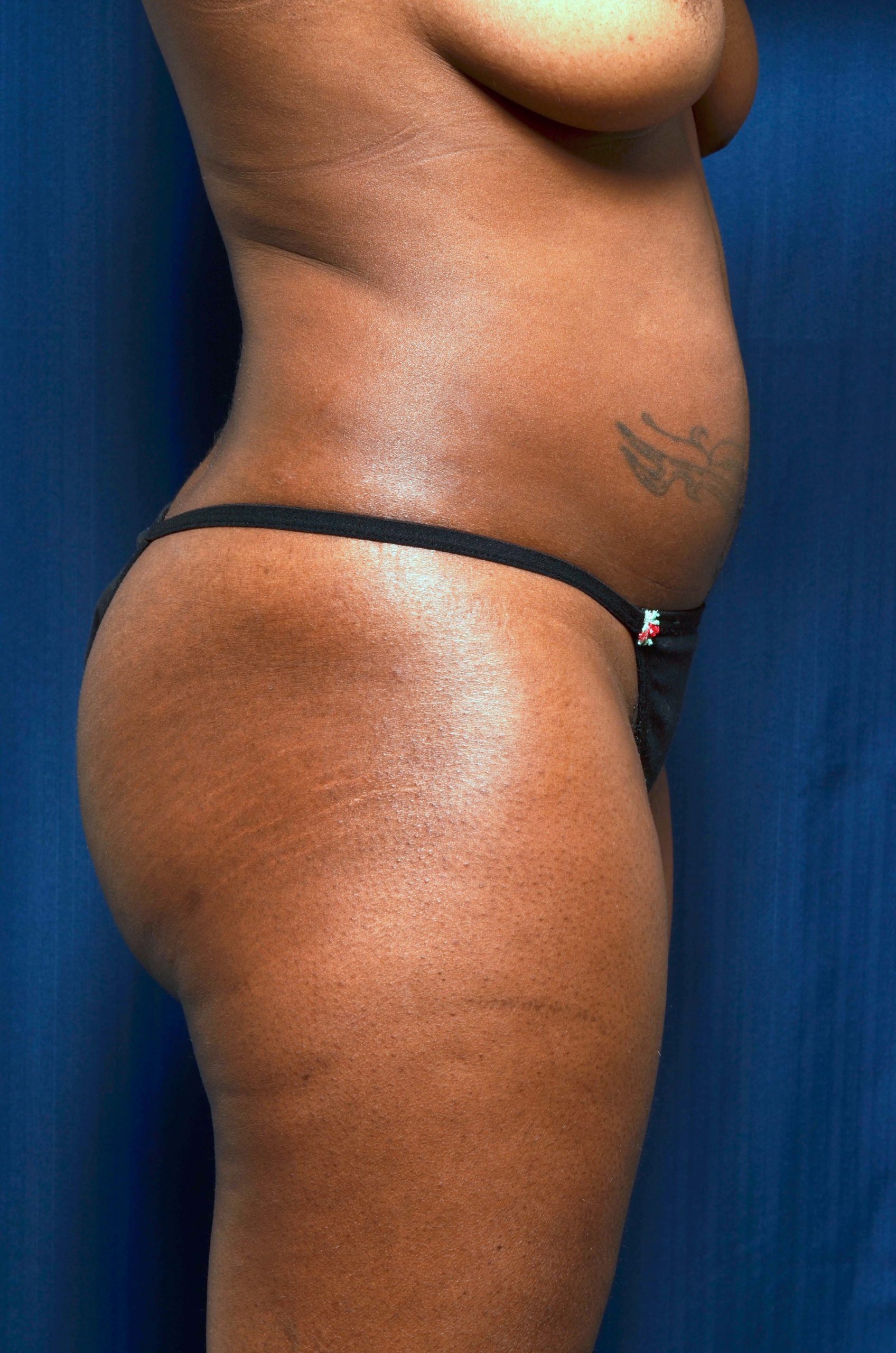Brazilian Butt Lift Before & After