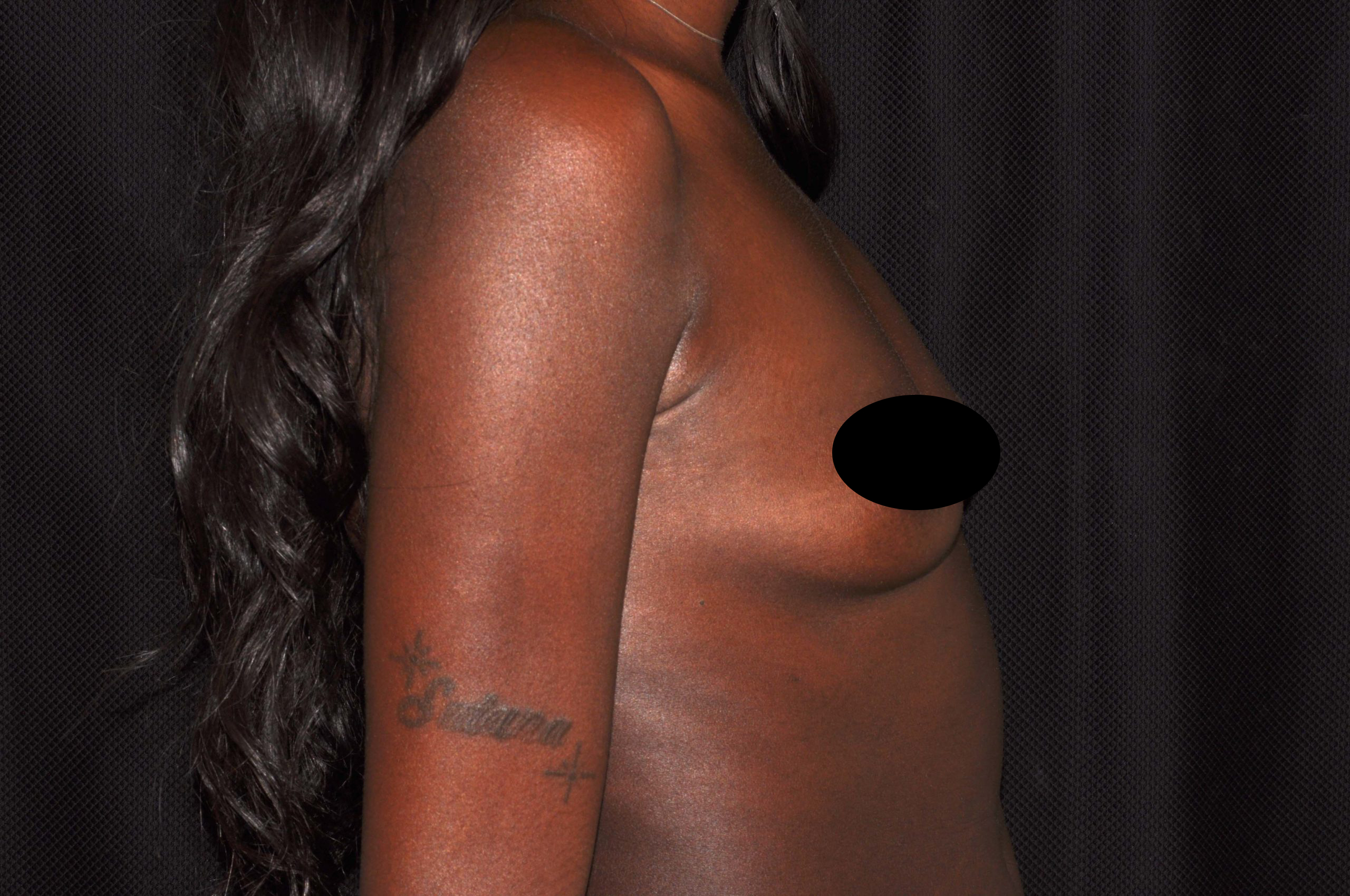 Breast Augmentation Before and After