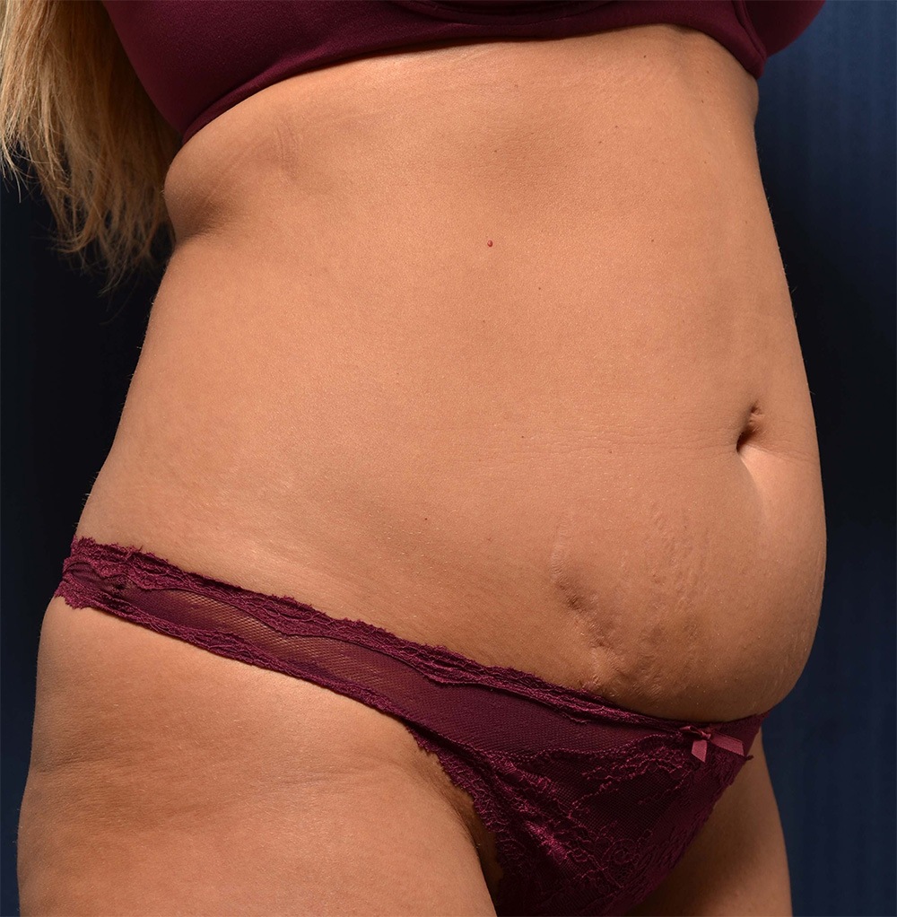 Tummy Tuck