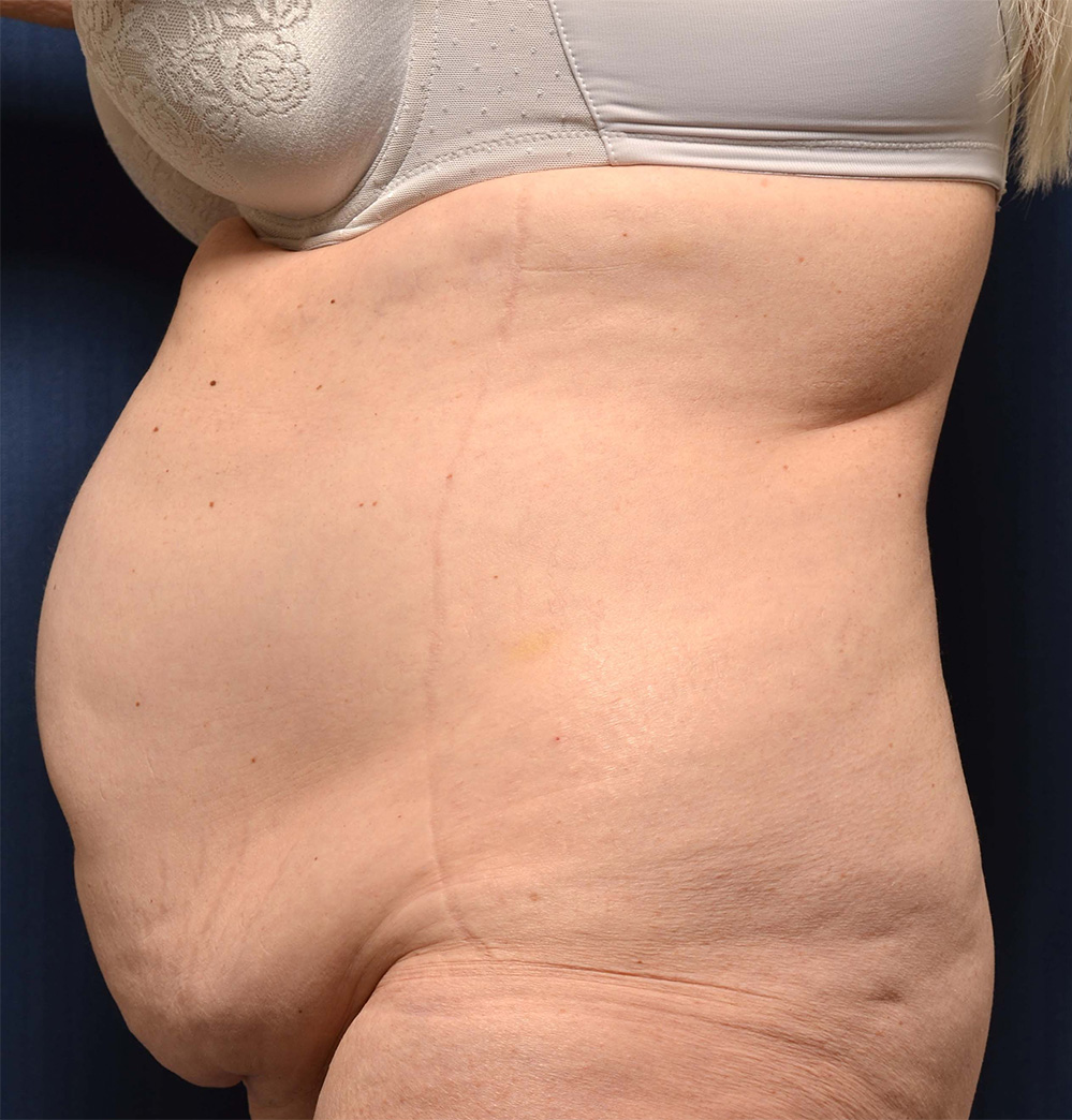 Tummy Tuck