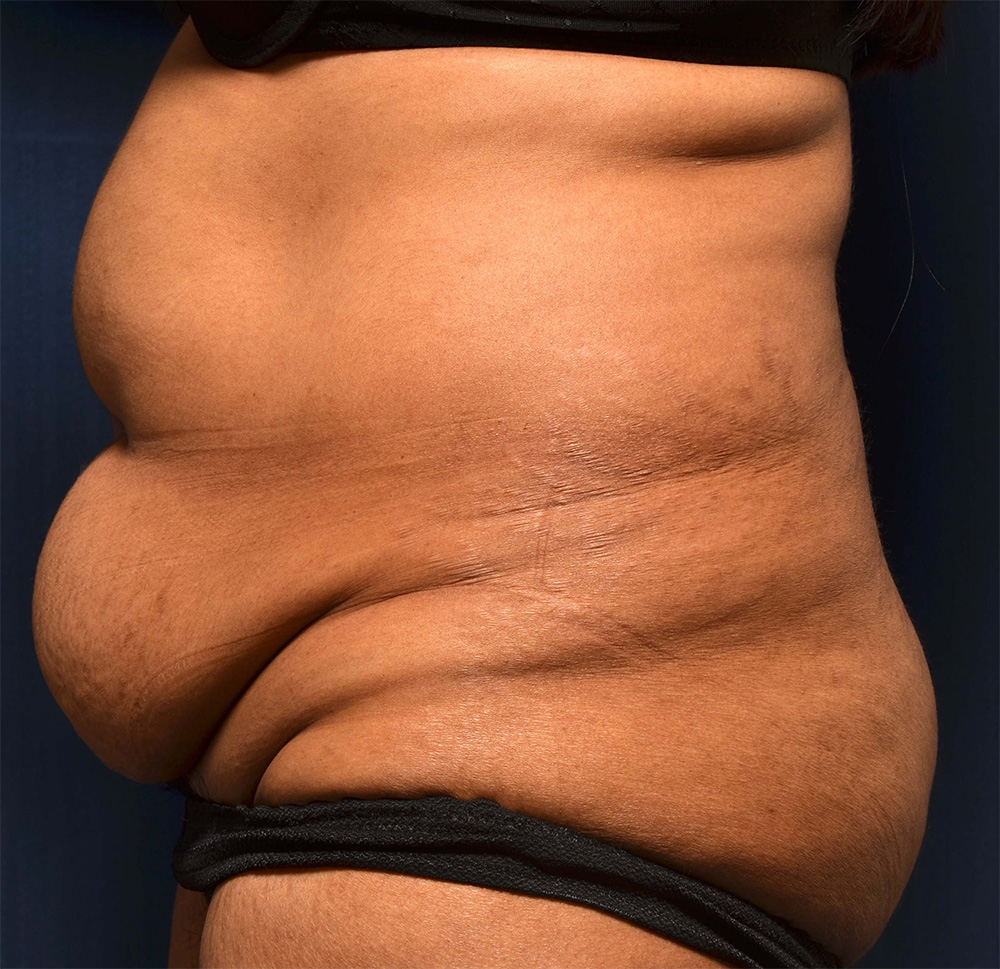 Tummy Tuck