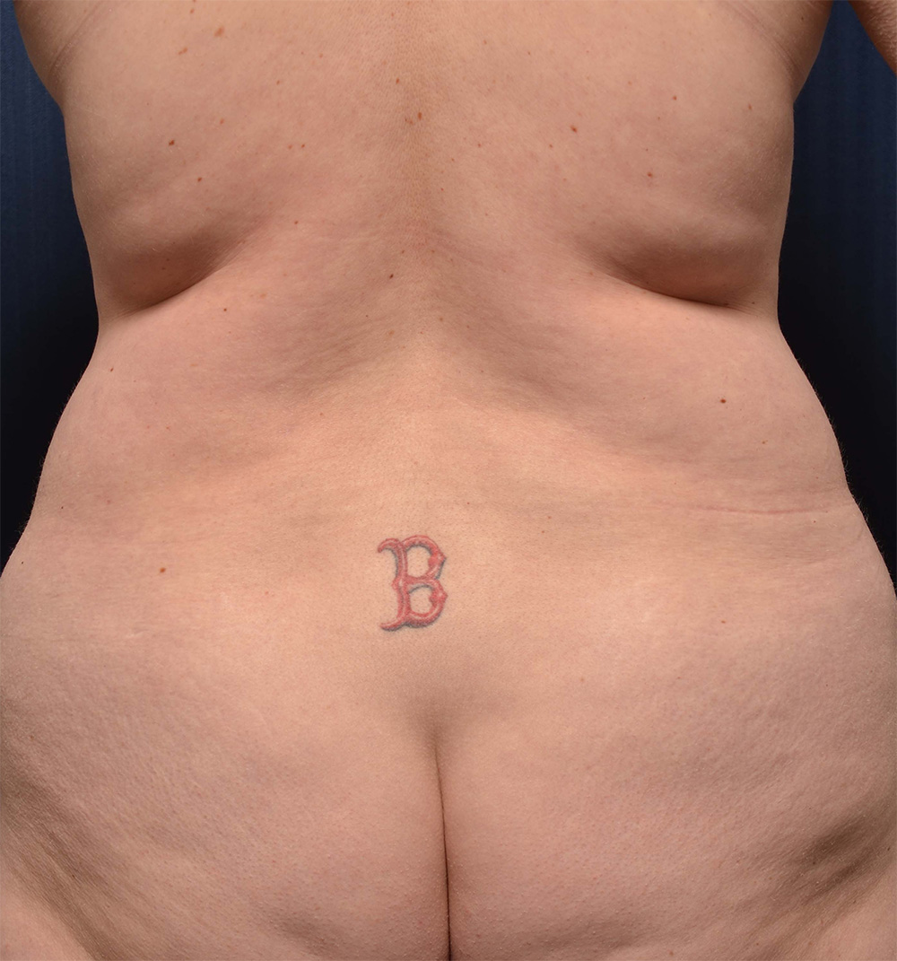 Tummy Tuck