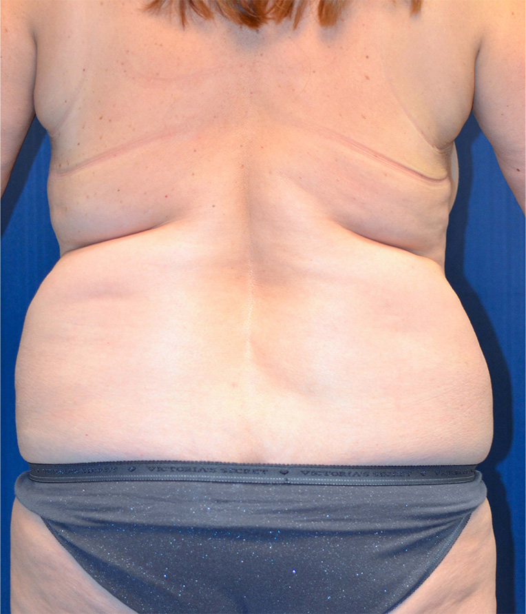 Tummy Tuck