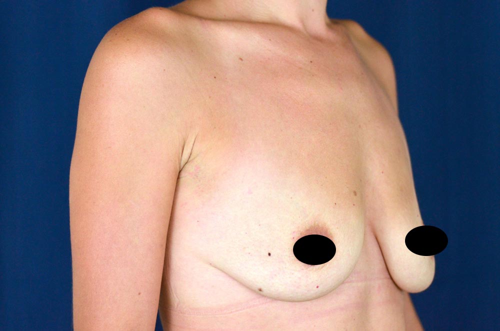 Breast Augmentation with Lift