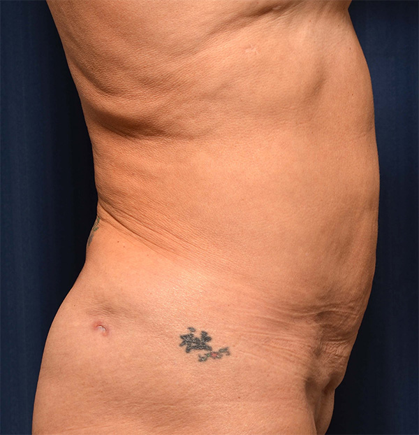 Tummy Tuck