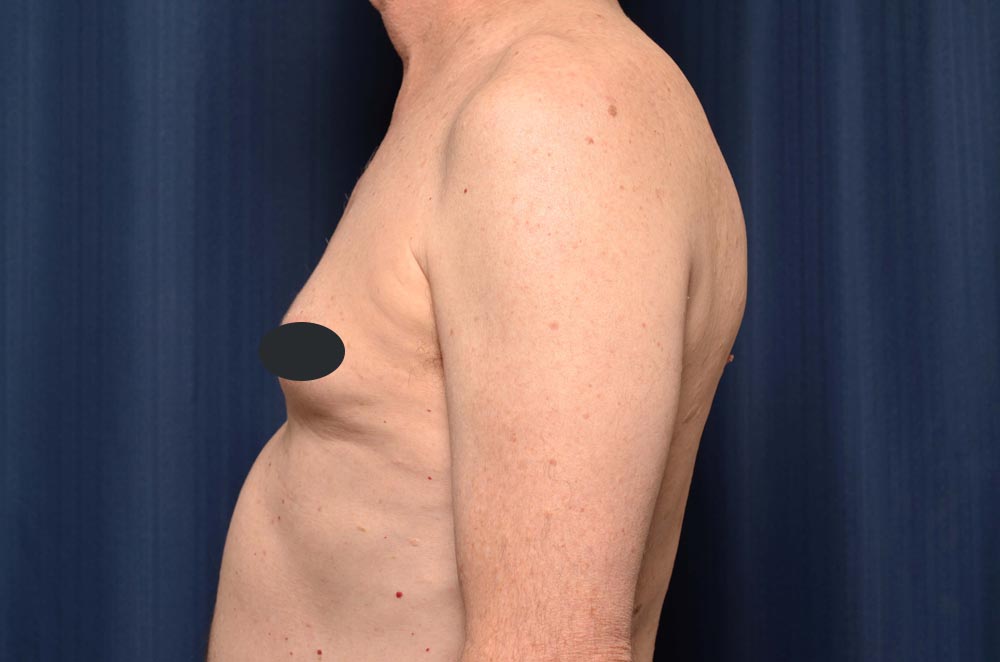 Gynecomastia