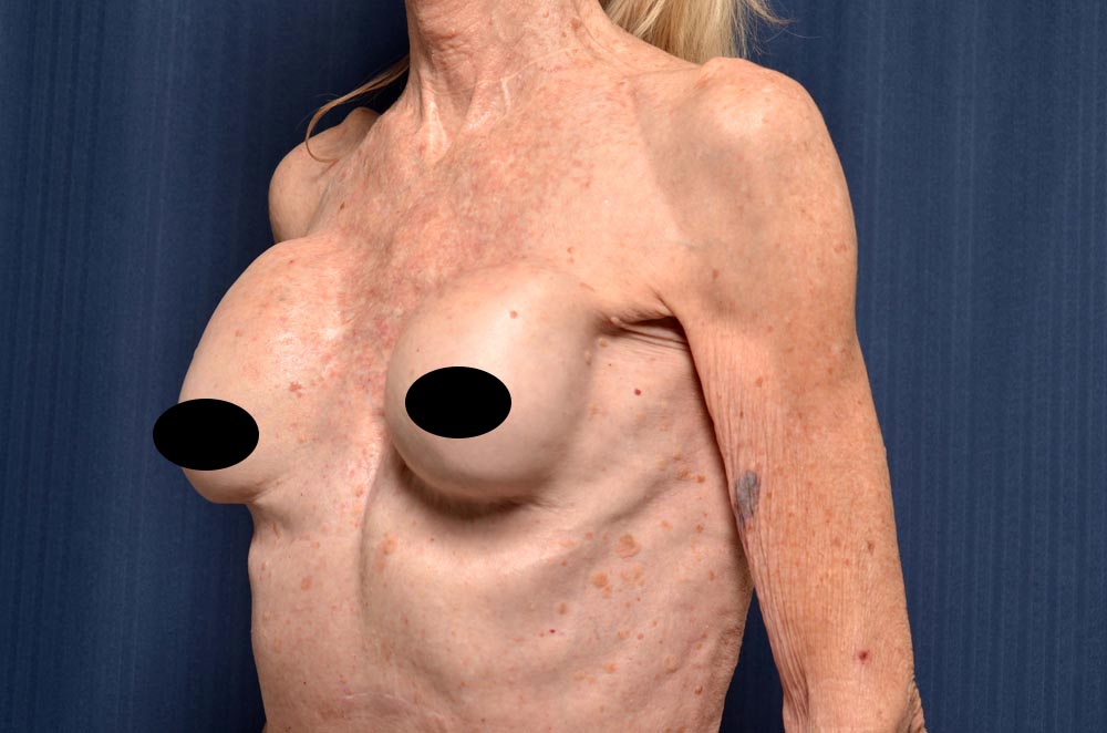 Breast Implant Revision