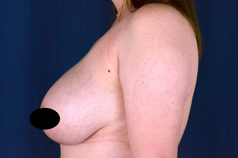 Breast Lift Reduction