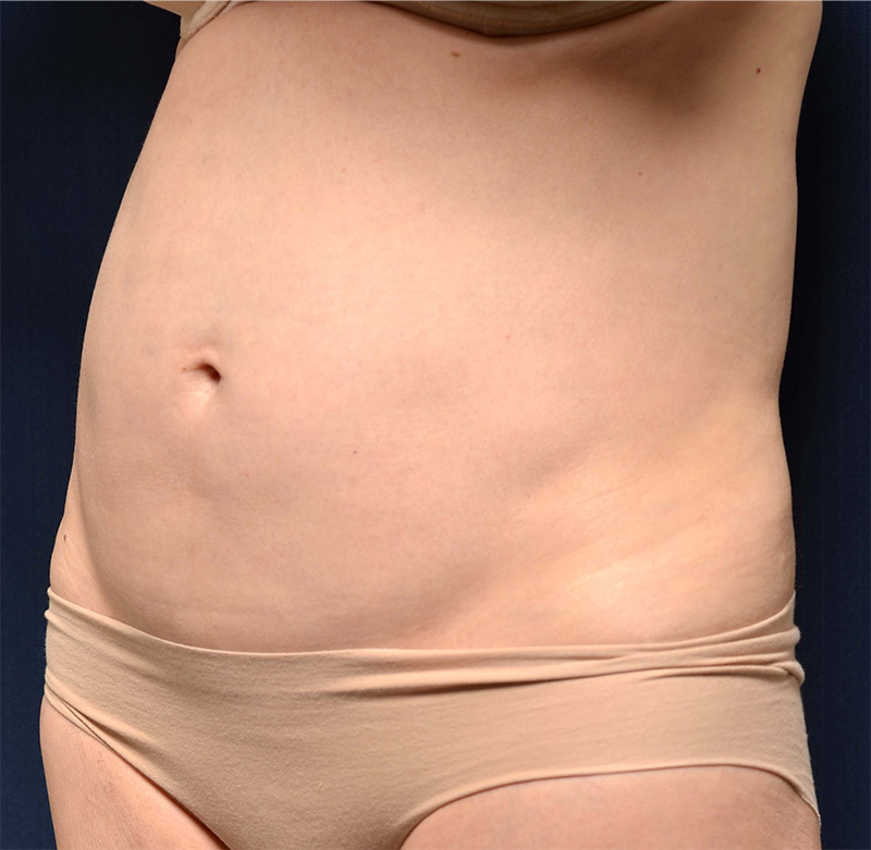 Tummy Tuck