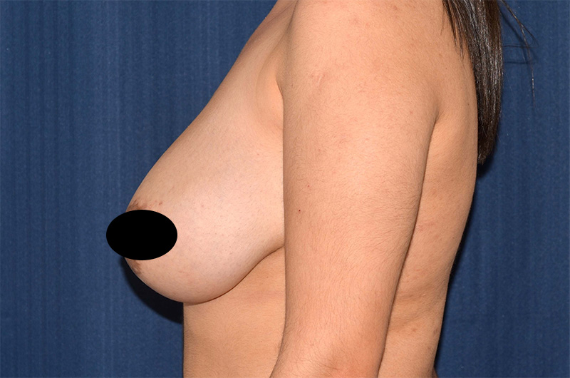 Breast Lift Reduction