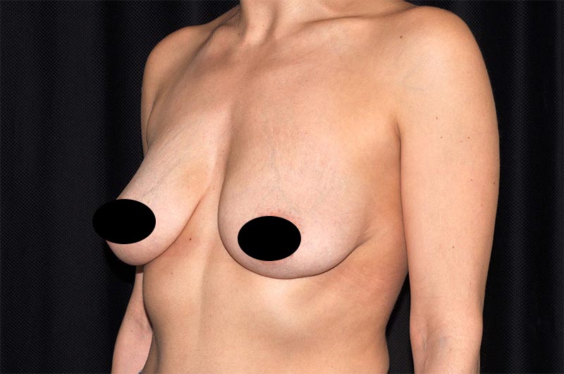 Breast Lift Reduction