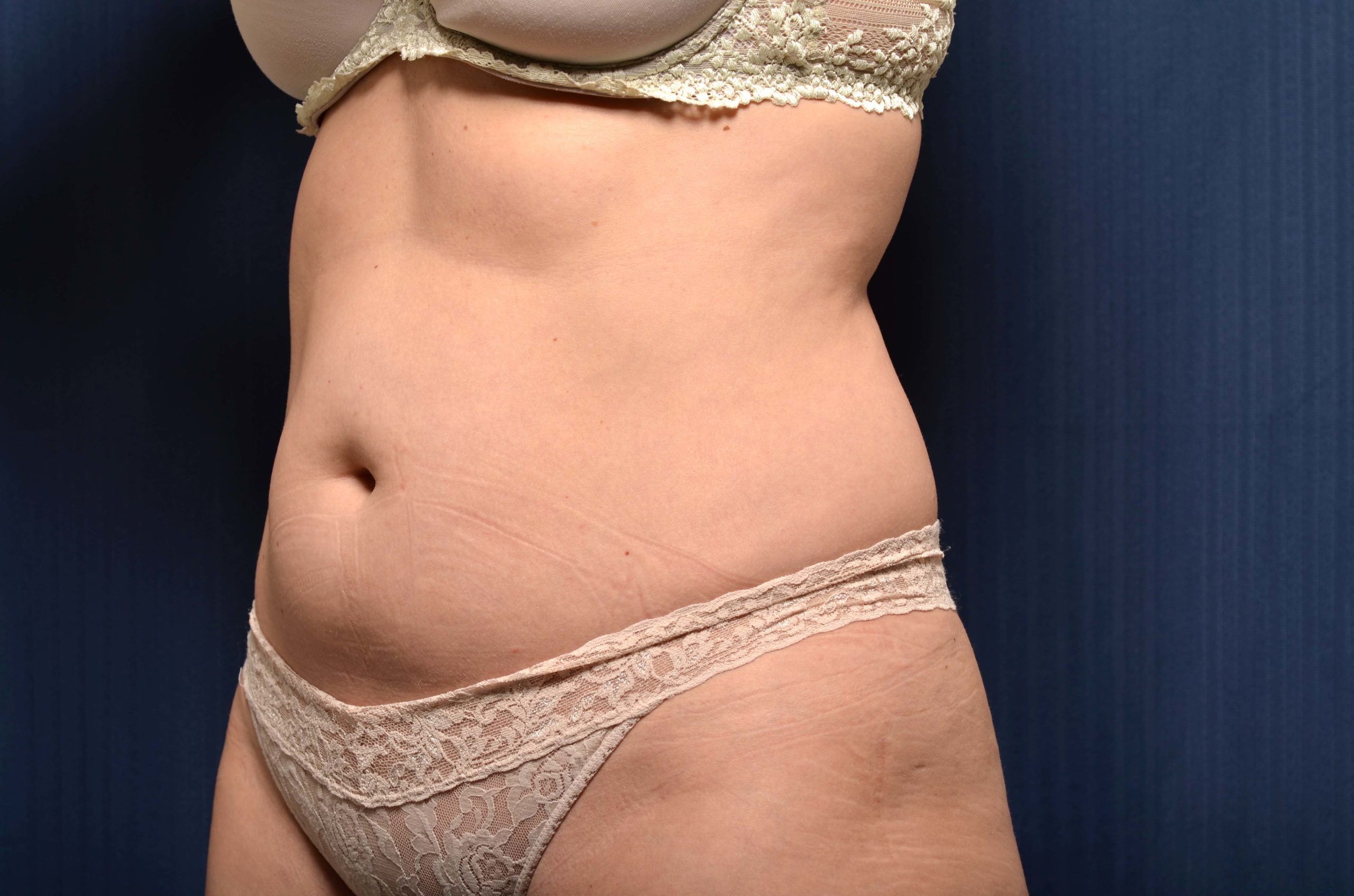 Liposuction