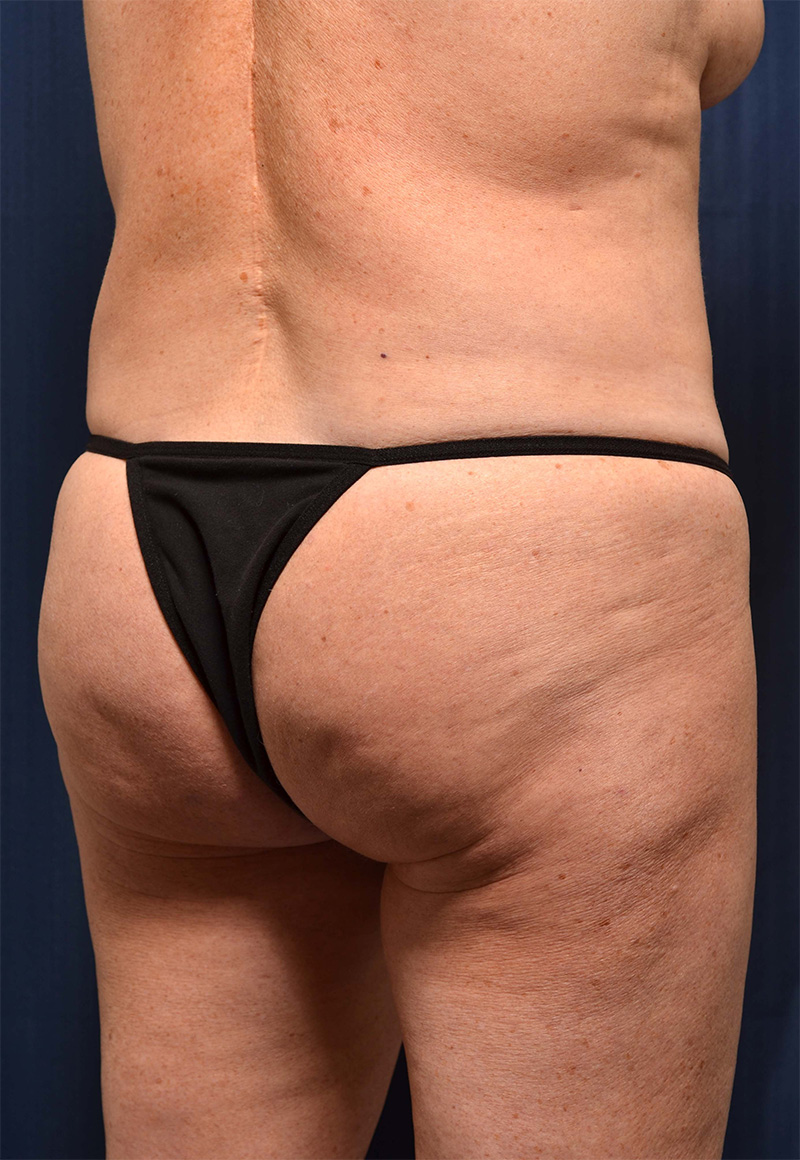 Brazilian Butt Lift Before & After